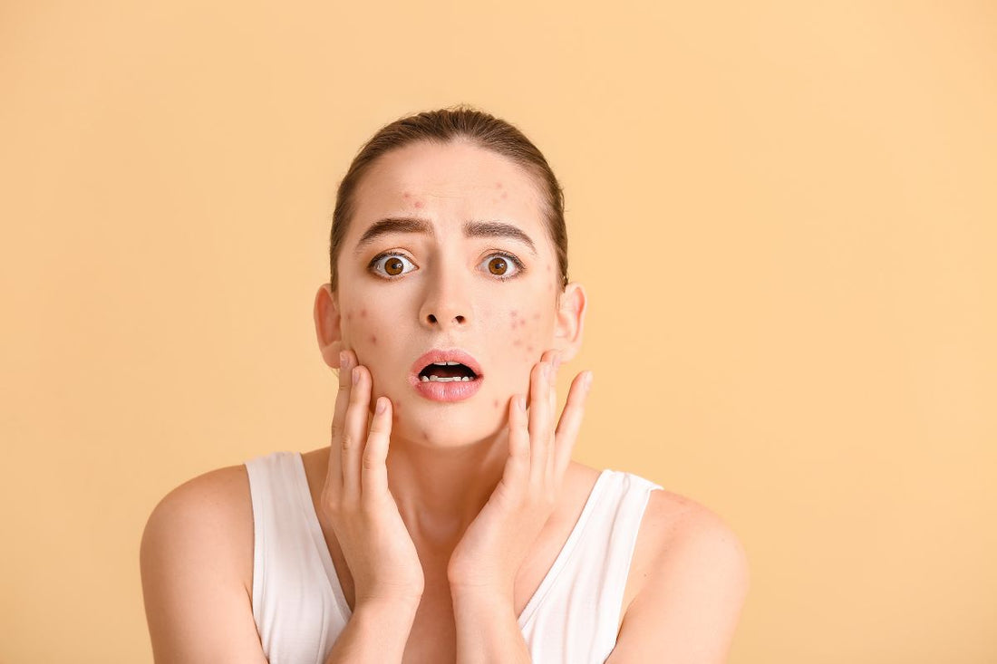 Acne Problems? Here's How Ayurveda with Neem and Turmeric can Save Your Skin